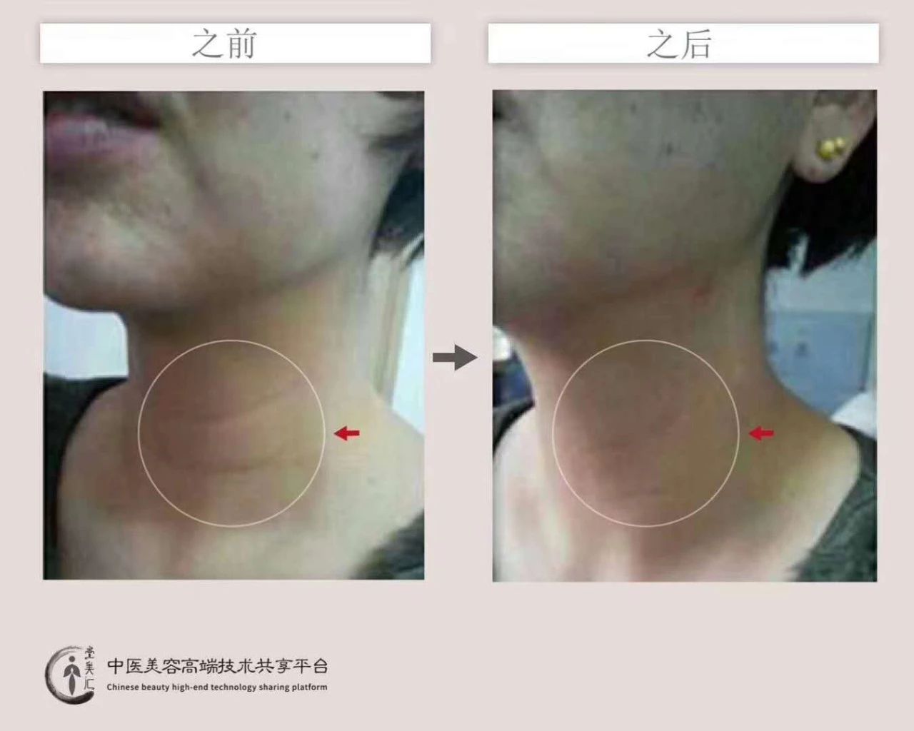 针灸能美容,抗衰老,明星都在做,你知道吗