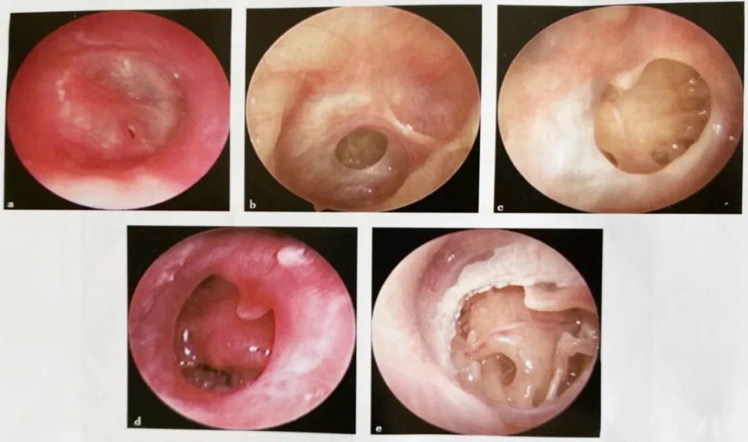 耳鼻喉镜篇耳内镜下治疗慢性化脓性中耳炎