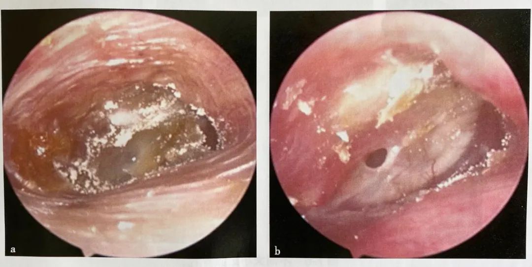 耳鼻喉镜篇耳内镜下治疗慢性化脓性中耳炎