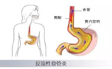 反流性食管炎是由胃,十二指肠内容物反流入食管引起的食管炎症性病变.