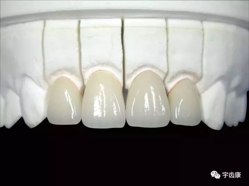 镍铬、钴铬、贵金属和全瓷牙那个好？资深牙医告诉你！