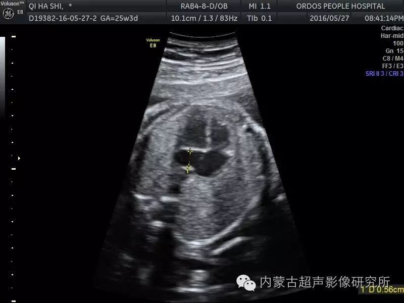 病例报告:超声诊断胎儿永存左上腔静脉一例