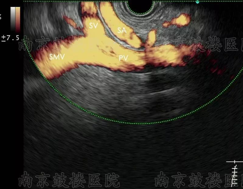 胃内静脉性海鸥: 脾静脉(sv),肠系膜上静脉(smv)和门静脉(pv)起始