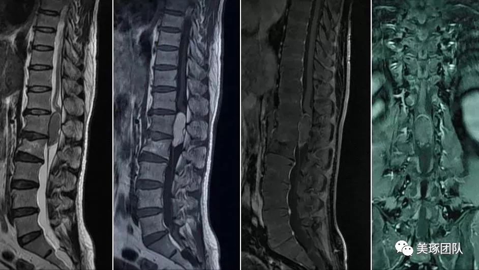 图为mdg脊髓圆锥畸胎瘤的案例