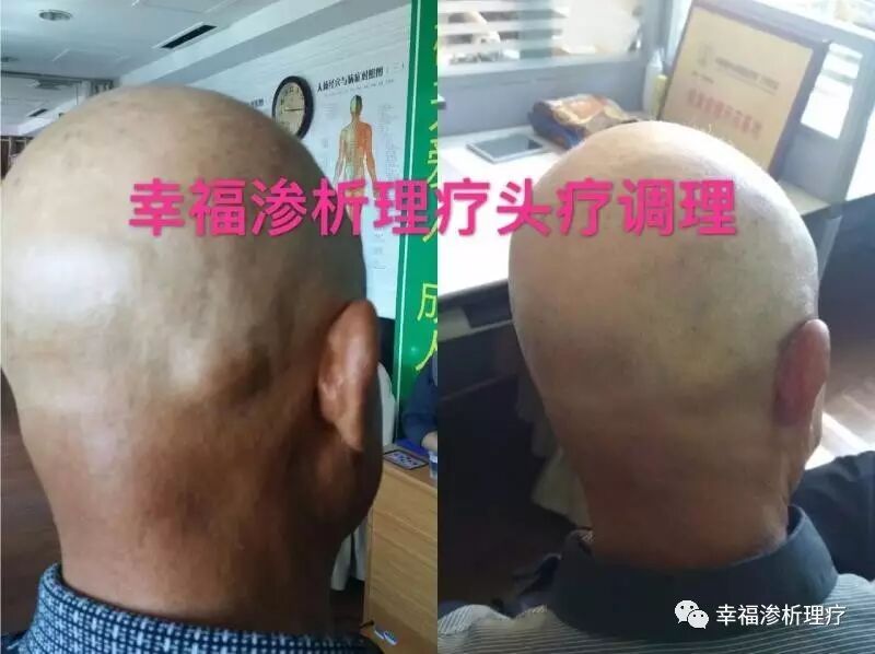 幸福渗析理疗治疗脂肪瘤效果好!
