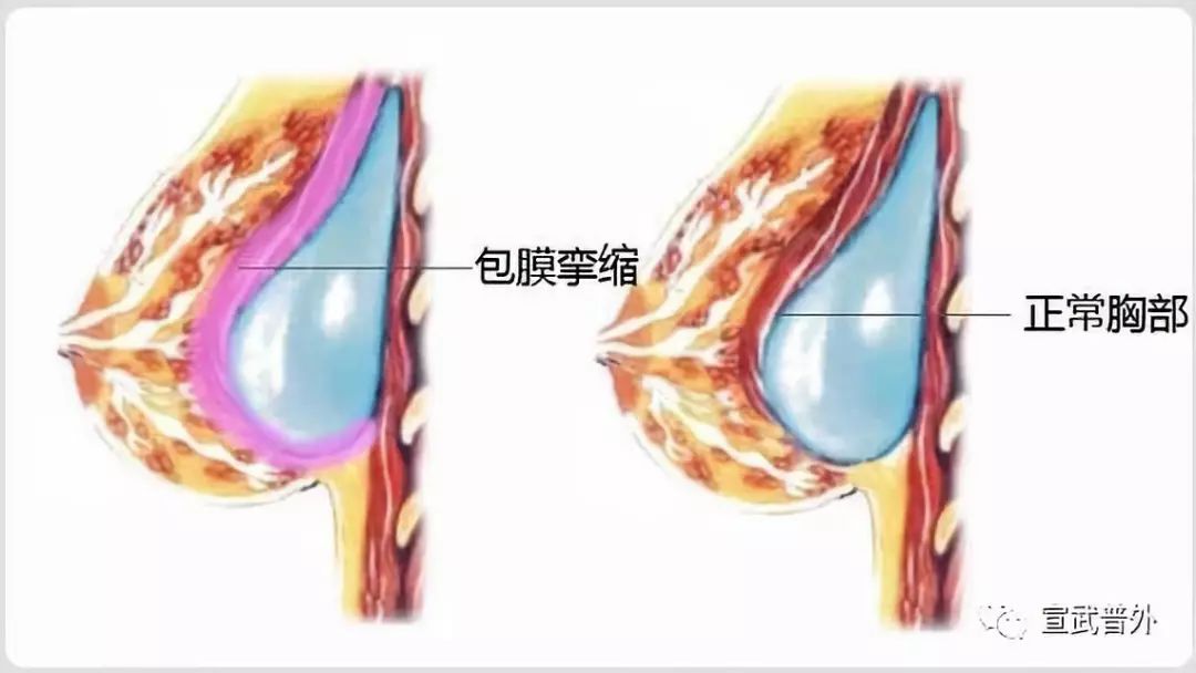 乳房全切手术后,形象不完整,怎么办?可以试试这个方法