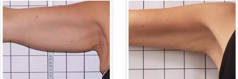 多极射频是什么紧致塑形——射频_https://www.jmylbn.com_新闻资讯_第8张