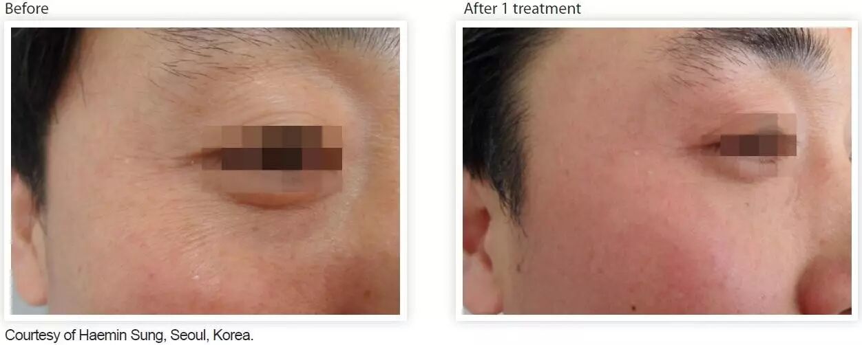 多极射频是什么紧致塑形——射频_https://www.jmylbn.com_新闻资讯_第5张