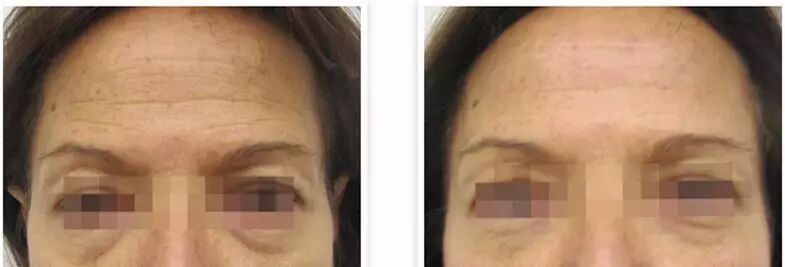 多极射频是什么紧致塑形——射频_https://www.jmylbn.com_新闻资讯_第4张