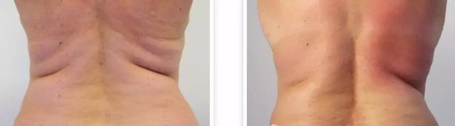 多极射频是什么紧致塑形——射频_https://www.jmylbn.com_新闻资讯_第6张