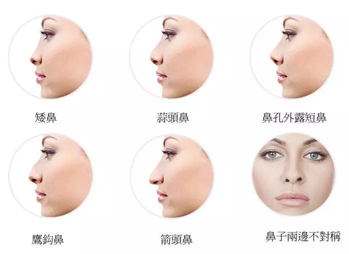 为什么做了隆鼻手术,鼻子还是不好看?