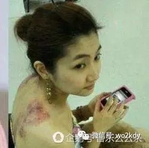 Selina烧伤后伤疤触目惊心,和张承中的婚姻背后真相!