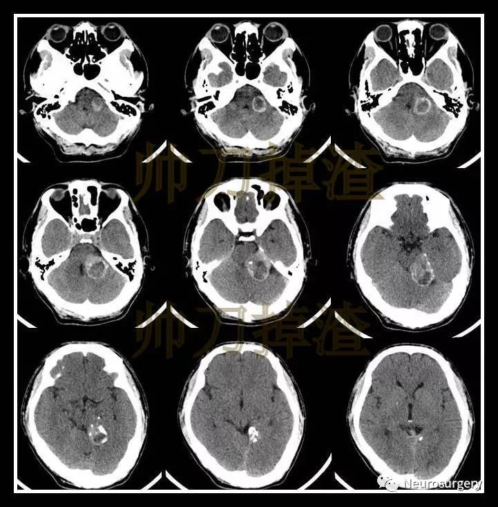 术前ct 术前mri 左侧小脑幕上下可见团块状稍长t1混杂t2信号影,flair