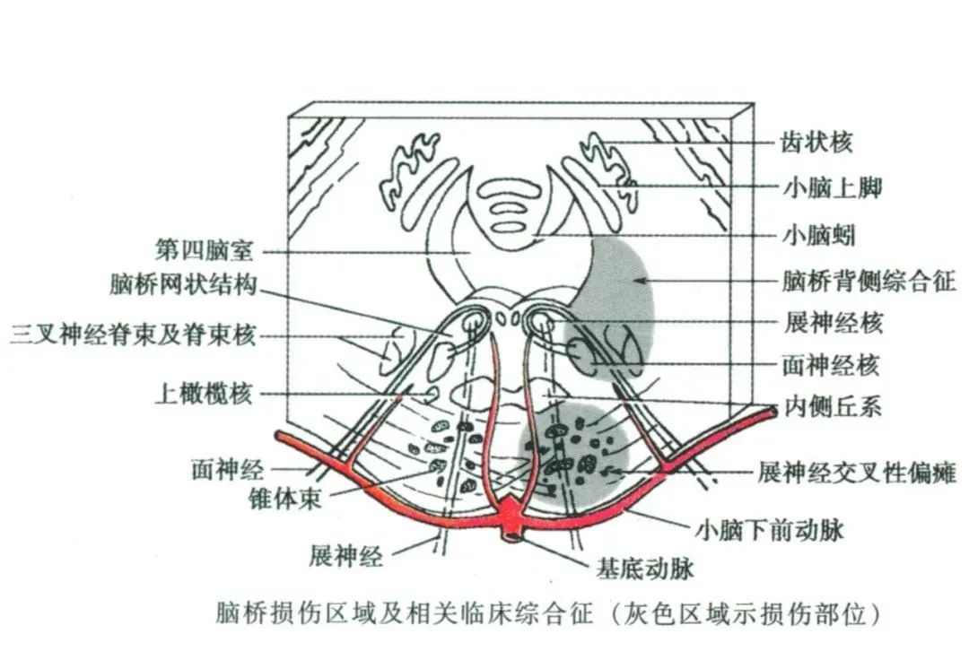 脑干综合征的简洁记忆总结中脑大脑脚脚底【眼【锥】中脑被盖腹