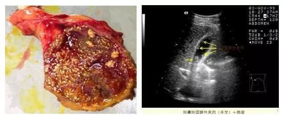 超声医生教你了解"胆囊息肉"