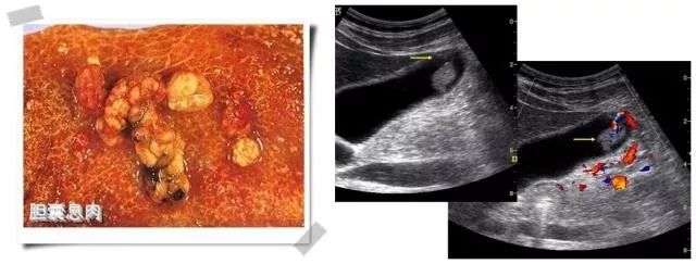 超声医生教你了解"胆囊息肉"