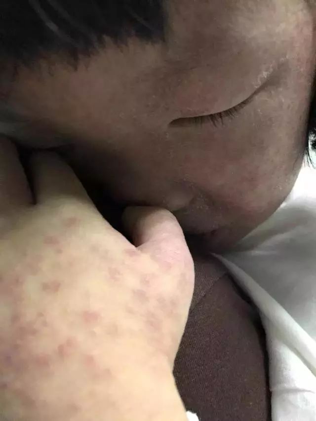 医生怀疑小美患的是"猩红热",可在用药后,却出现全身严重过敏症状.