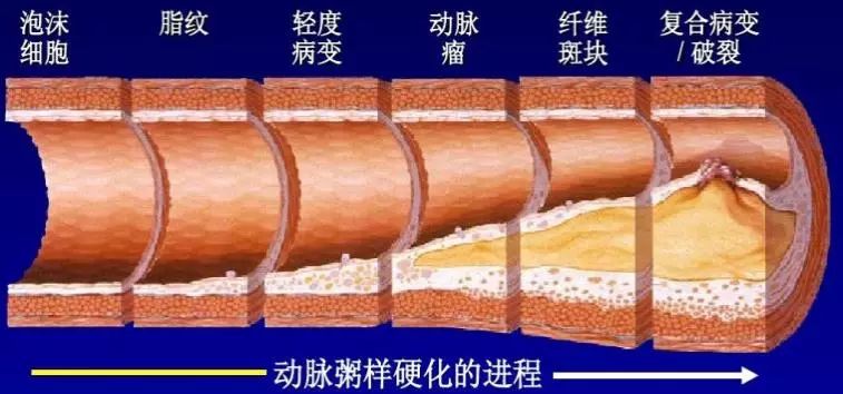 动脉粥样硬化的进程