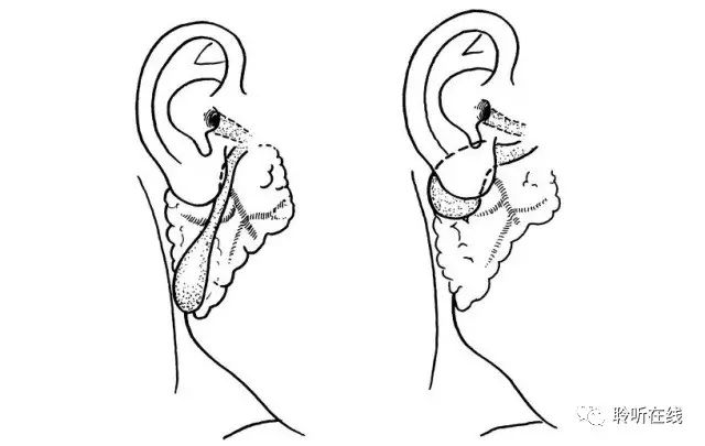 瘘管开口多位于耳轮脚前,少数可在耳廓之三角