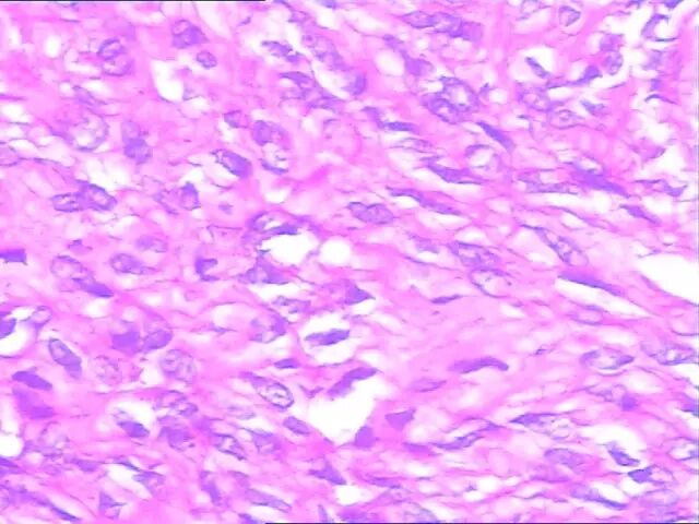 都转移了，怎么还是良性肿瘤？