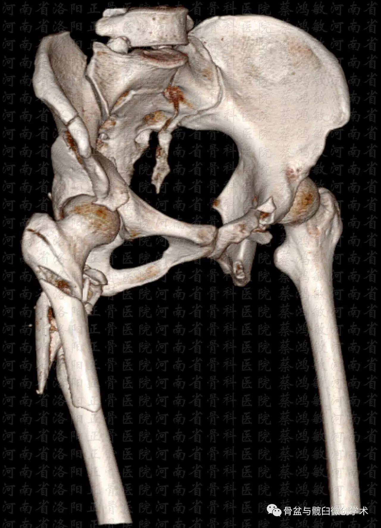 髋臼双柱加后壁骨折合并骨盆垂直不稳定型骨折的治疗