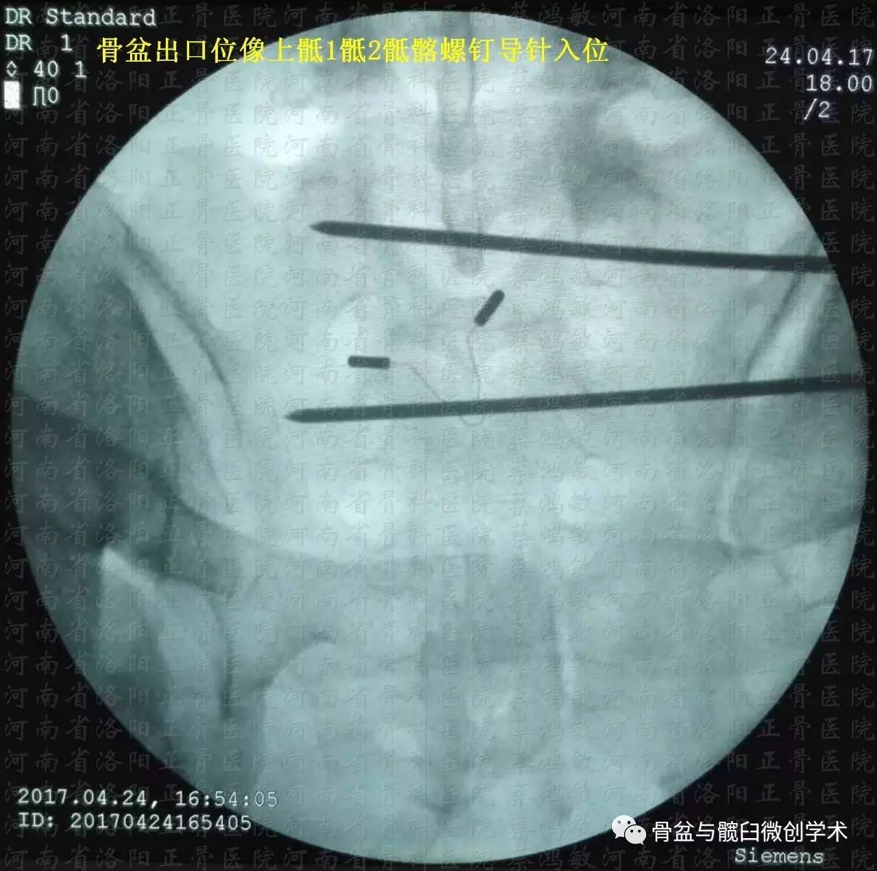 髋臼骨折复位固定完毕,经髂腹股沟入路远端进行 stoppa入路显露左侧