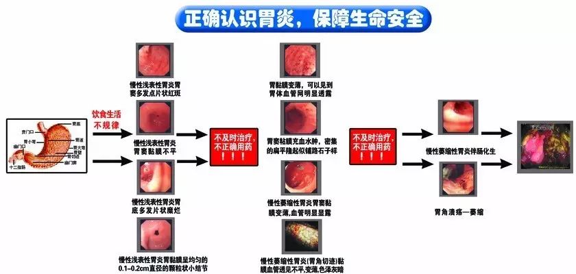 萎缩性胃炎患者可有贫血,舌炎,腹泻等,个别病人伴粘膜糜烂者上