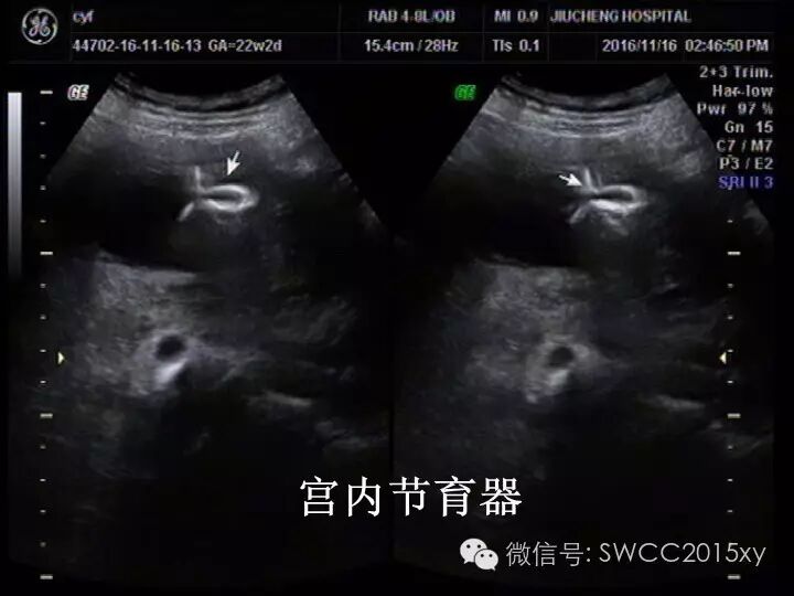 宫内有节育器咋还会怀孕,对胎儿有影响吗?-怀孕期