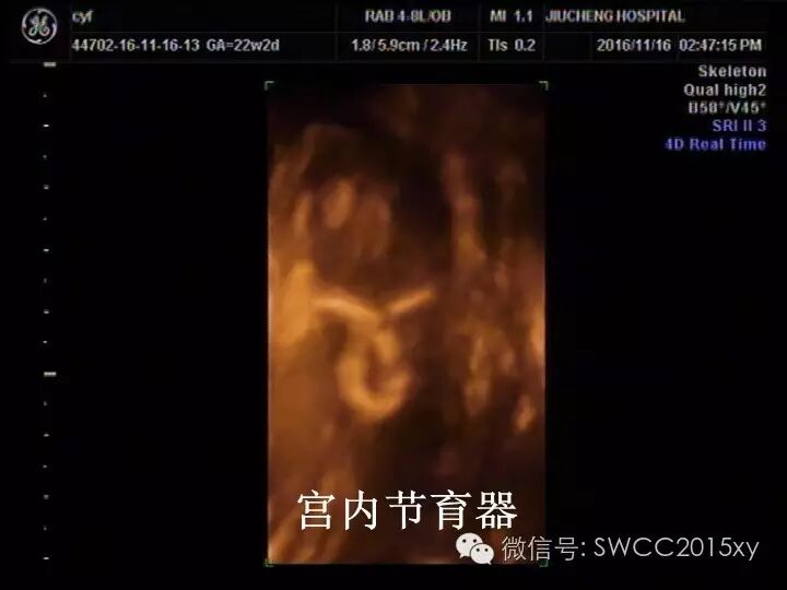 宫内有节育器咋还会怀孕,对胎儿有影响吗?-怀孕期