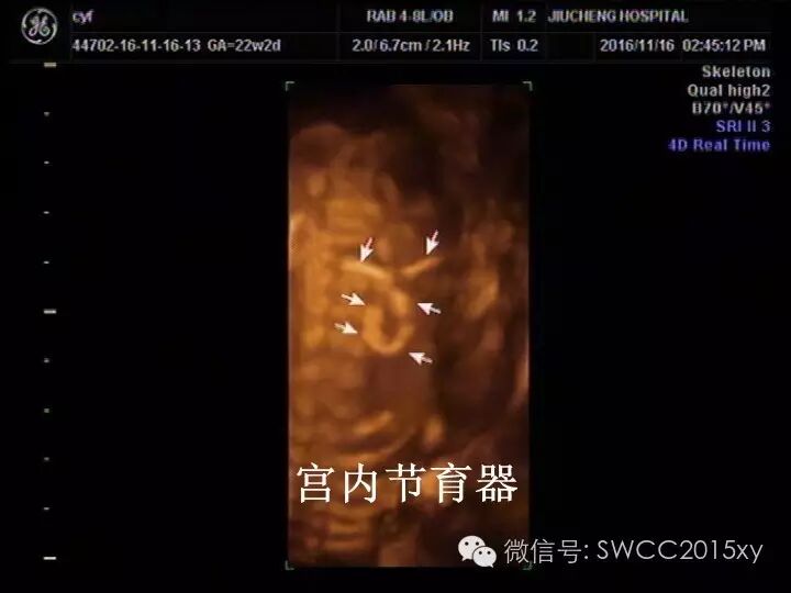 宫内有节育器咋还会怀孕,对胎儿有影响吗?-怀孕期