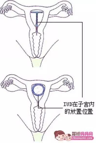 宫内有节育器咋还会怀孕,对胎儿有影响吗?-怀孕期