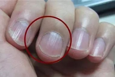 1,手指关节发红,微循环不好,补胡萝卜素a,蛋白质; 2,手指尖中间发黑