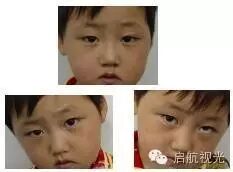眼突计怎么用【微讲堂】斜视检查方法大全_https://www.jmylbn.com_新闻资讯_第1张