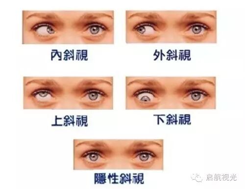 眼突计怎么用【微讲堂】斜视检查方法大全_https://www.jmylbn.com_新闻资讯_第3张