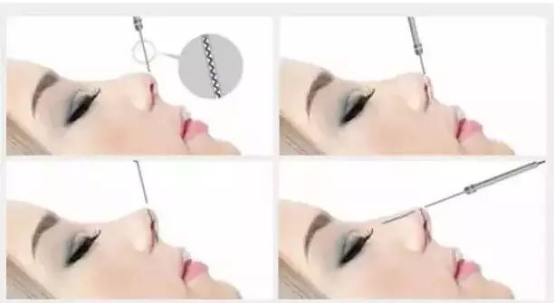 杭州时光埋线鼻