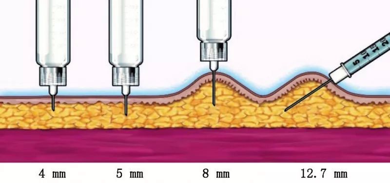 看看你的胰岛素注射针头长度合适吗?注射不同部位是否