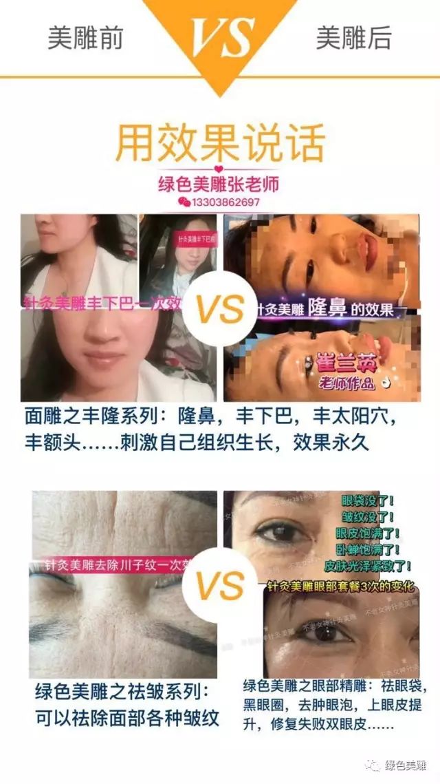 绿色针灸美雕美容减肥纯技术纯绿色疗法13303862697