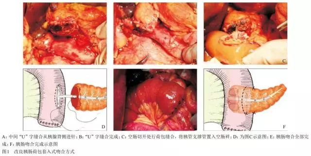 医学新闻 正文  观察术中胰肠吻合时间及术中出血量,检测术后第3,5,7