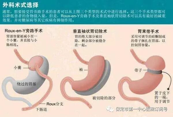 減肥手術多少錢_減肥手術哪種方式最好_手術減肥