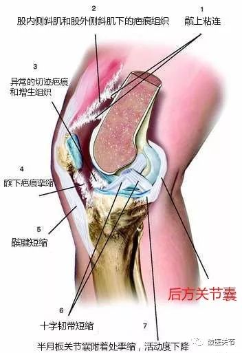 长期伸不直会导致膝关节周围组织尤其是后方组织挛缩,粘连