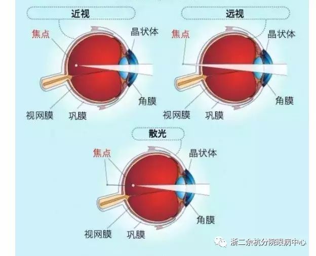 05 激光治疗近视的原理 近视眼其进入眼内的光线落在了视网膜前,所以