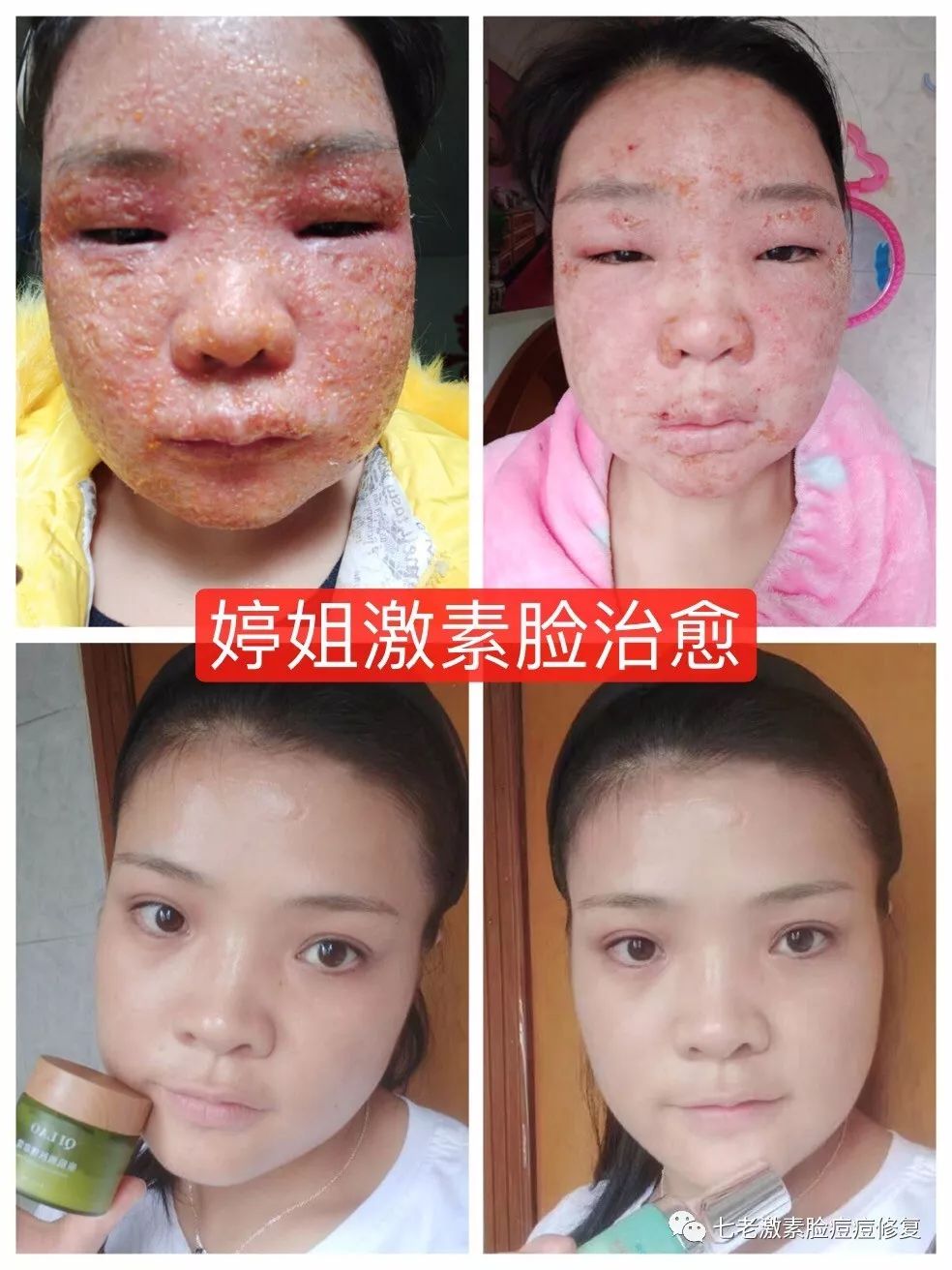 激素脸形成原因的什么?激素脸平时要注意什么?