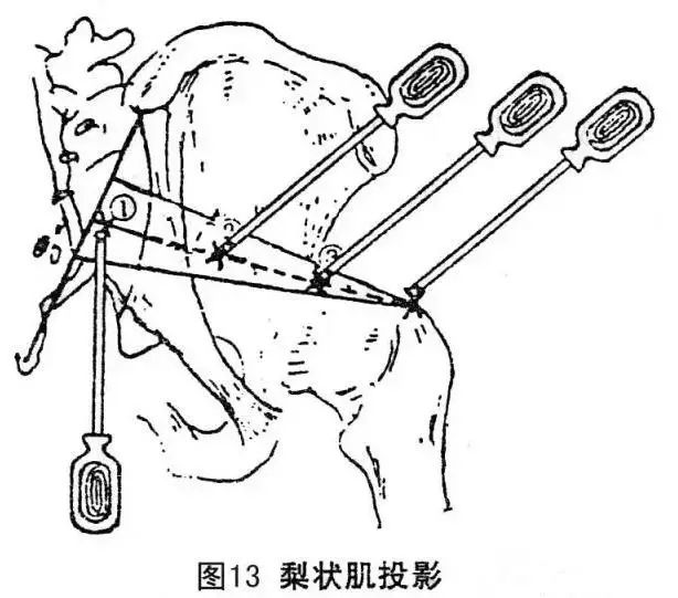 梨状肌综合征的整体治疗（附：视频）