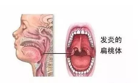 种非特异性急性炎症,常伴有一定程度的咽粘膜及咽淋巴组织的急性炎症