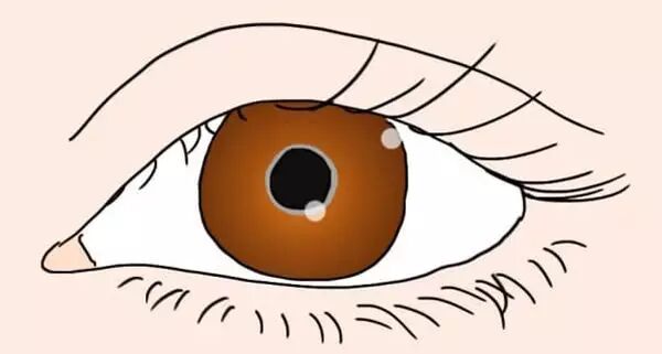 眼白隐含7大健康秘密!眼睛出现这现象,表示肝不好