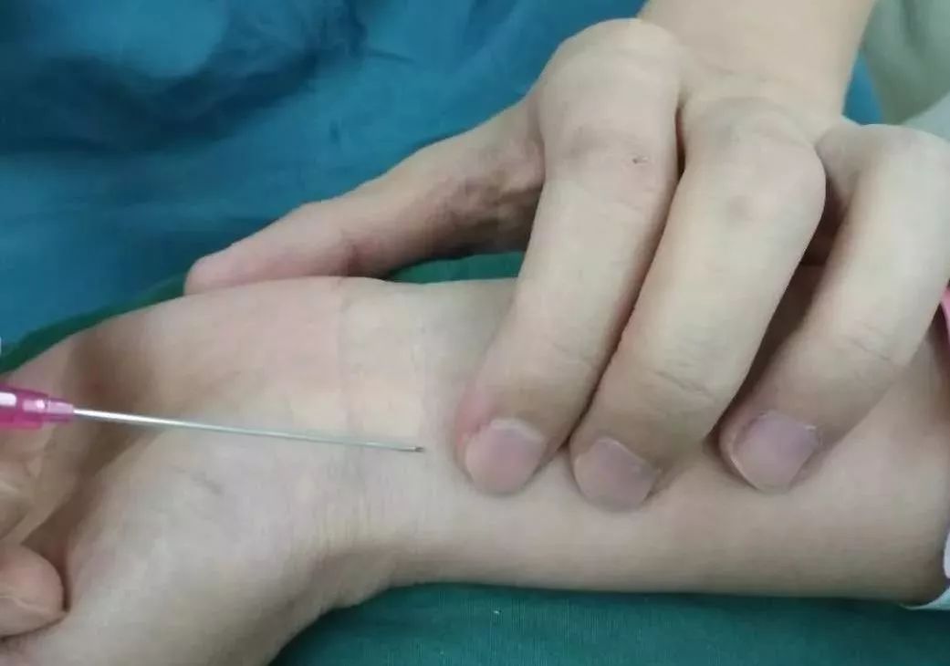 注意好这几个细节,能显著提高桡动脉穿刺成. - zhiji