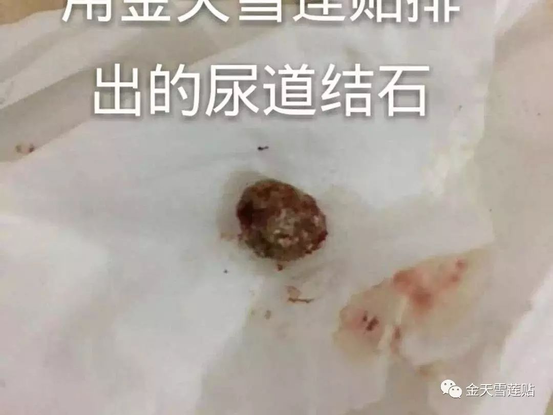 32mm卵巢囊肿贴没有了,排出尿道结石,人也越来越年轻健康幸福!