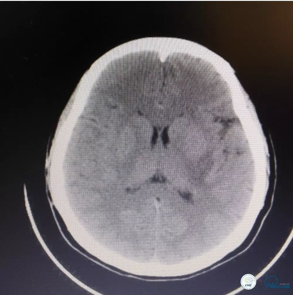 mri:左侧基底节区和放射冠脑梗死,病灶趋软化.