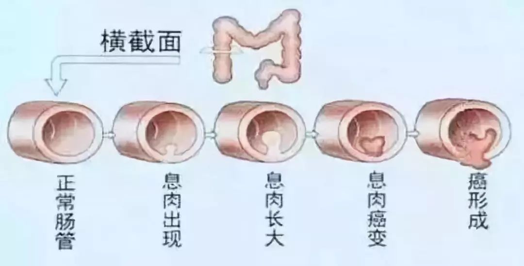 病人排便动作牵拉及肠蠕动刺激,可使蒂基周围的粘膜层松弛,可并发直肠