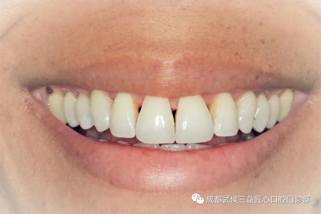 华西口腔医院 李宇 综合解析牙龈"黑三角" 两颗牙齿相邻部位不能被
